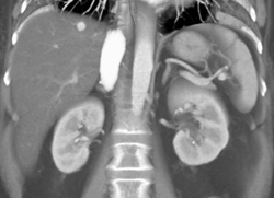 Hemangioma - CTisus CT Scan