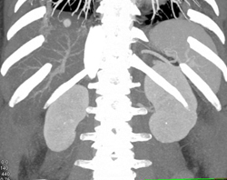 Hemangioma - CTisus CT Scan