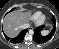 Hemangioma - CTisus CT Scan