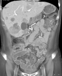 Liver Metastases With Carcinomatosis - CTisus CT Scan