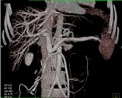 Occlusion of Superior Mesenteric Vein (SMV) in 3D - CTisus CT Scan