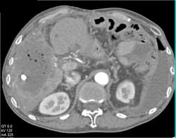 Liver Necrosis - CTisus CT Scan