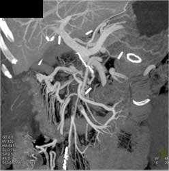 Superior Mesenteric Vein (SMV) Occlusion - CTisus CT Scan