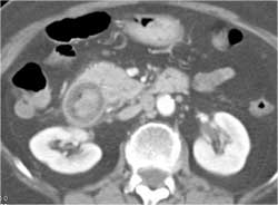 Gallstone Ileus With Pneumobilia - CTisus CT Scan