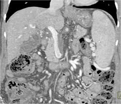 Cirrhosis With Varices and Portal Vein Thrombosis (PVT) - CTisus CT Scan