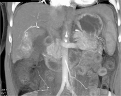 Neovascularity Due to Hepatoma - CTisus CT Scan