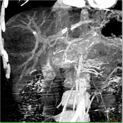 Hepatoma - CTisus CT Scan