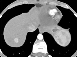 Focal Nodular Hyperplasia (FNH) - CTisus CT Scan