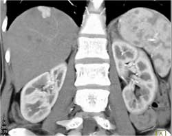 Focal Nodular Hyperplasia (FNH) - CTisus CT Scan