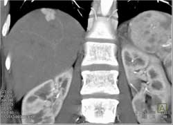 Focal Nodular Hyperplasia (FNH) - CTisus CT Scan