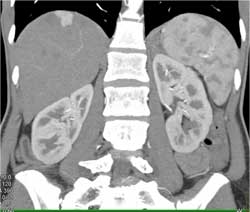 Focal Nodular Hyperplasia (FNH) - CTisus CT Scan