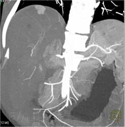 Focal Nodular Hyperplasia (FNH) - CTisus CT Scan