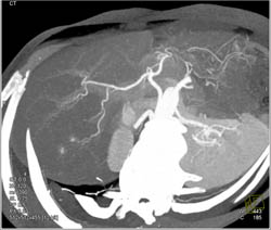 Hepatoma - CTisus CT Scan