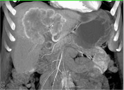 Hepatoma - CTisus CT Scan