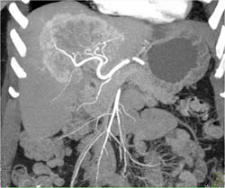 Hepatoma - CTisus CT Scan