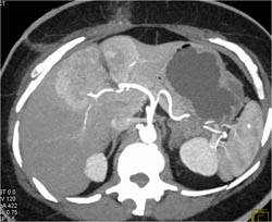 Neovascularity - CTisus CT Scan