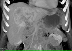 Hepatoma in Washout Phase - CTisus CT Scan