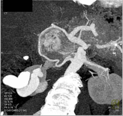 Islet Cell Invades the Portal Vein - CTisus CT Scan