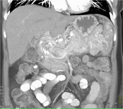 Portal Vein Thrombosis (PVT) With Huge Collaterals - CTisus CT Scan