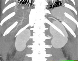 Hemangioma - CTisus CT Scan