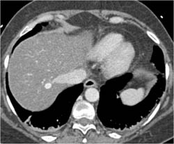 Hemangioma - CTisus CT Scan