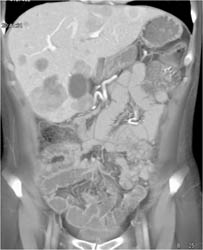 Liver Metastases Due to Carcinomatosis - CTisus CT Scan