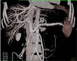 Occluded Superior Mesenteric Vein (SMV) - CTisus CT Scan