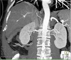 Hemangioma - CTisus CT Scan