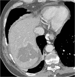 Hemangioma - CTisus CT Scan