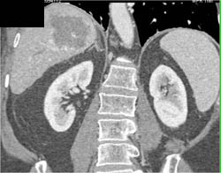 Hemangioma - CTisus CT Scan