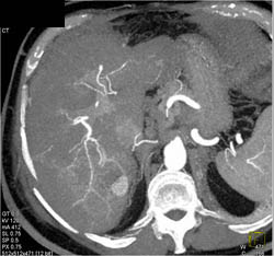 Hemangioma - CTisus CT Scan