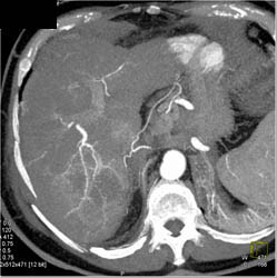 Hemangioma - CTisus CT Scan