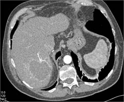 Hemangioma - CTisus CT Scan