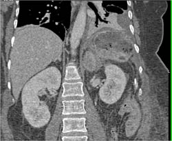 Perisplenic Abscess - CTisus CT Scan