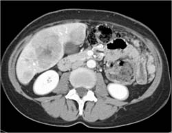 Liver Metastases and Omental Implants - CTisus CT Scan