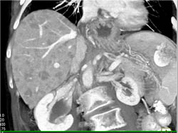 Liver Metastases Only Seen on VRT Image and Not MIPs - CTisus CT Scan