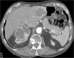 Hemangioma and Renal Cell Carcinoma - CTisus CT Scan