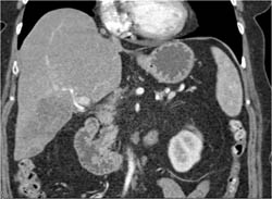 Focal Fatty Liver Simulates A Mass - CTisus CT Scan