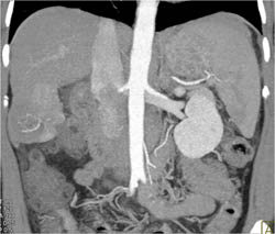 Subtle Neovascularity and Hepatoma - CTisus CT Scan