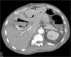 Hepatic Abscess and Infarct - CTisus CT Scan