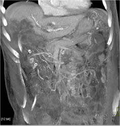 Cholangiocarcinoma - CTisus CT Scan