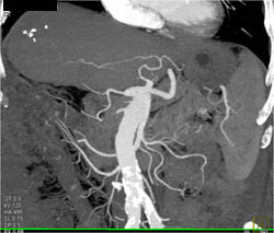 Cholangiocarcinoma - CTisus CT Scan