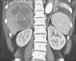 Liver Abscess - CTisus CT Scan