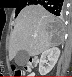 Liver Abscess - CTisus CT Scan