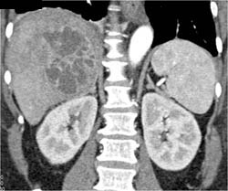 Liver Abscess - CTisus CT Scan