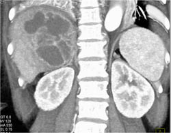 Liver Abscess - CTisus CT Scan