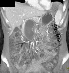 Dilated Occluded Portal Vein With Huge Collaterals- Cavernous Transformation of the Portal Vein (CTPV) - CTisus CT Scan