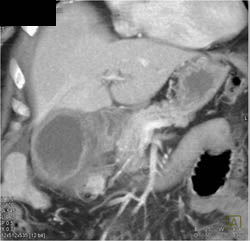 Acute Cholecystitis - CTisus CT Scan