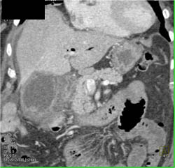 Acute Cholecystitis - CTisus CT Scan