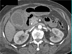 Acute Cholecystitis - CTisus CT Scan